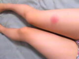 Insect bite leg fetish images please
